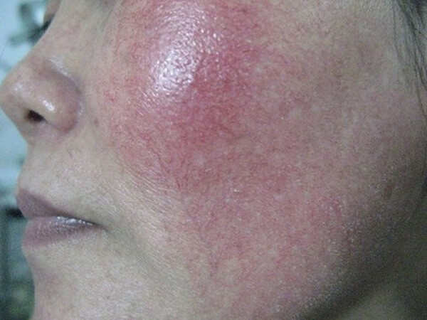 khuon-mat-bien-chung-sau-mot-thoi-gian-dung-kem-tron